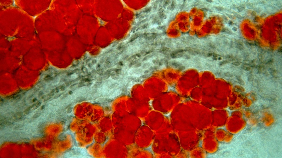Experimental CBL-514 injection may reduce fat, but safety questions remain