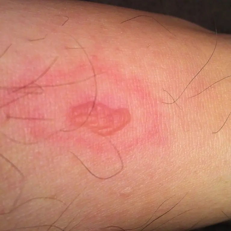 Biss-Loxosceles-laeta