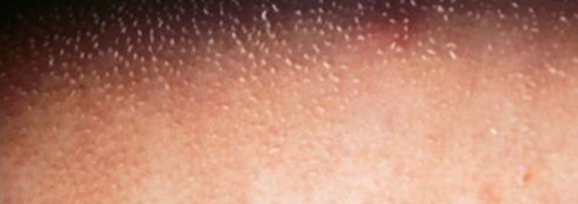 Gänsehautartige Verhornungsstörung der Haut (Ichthyosis).