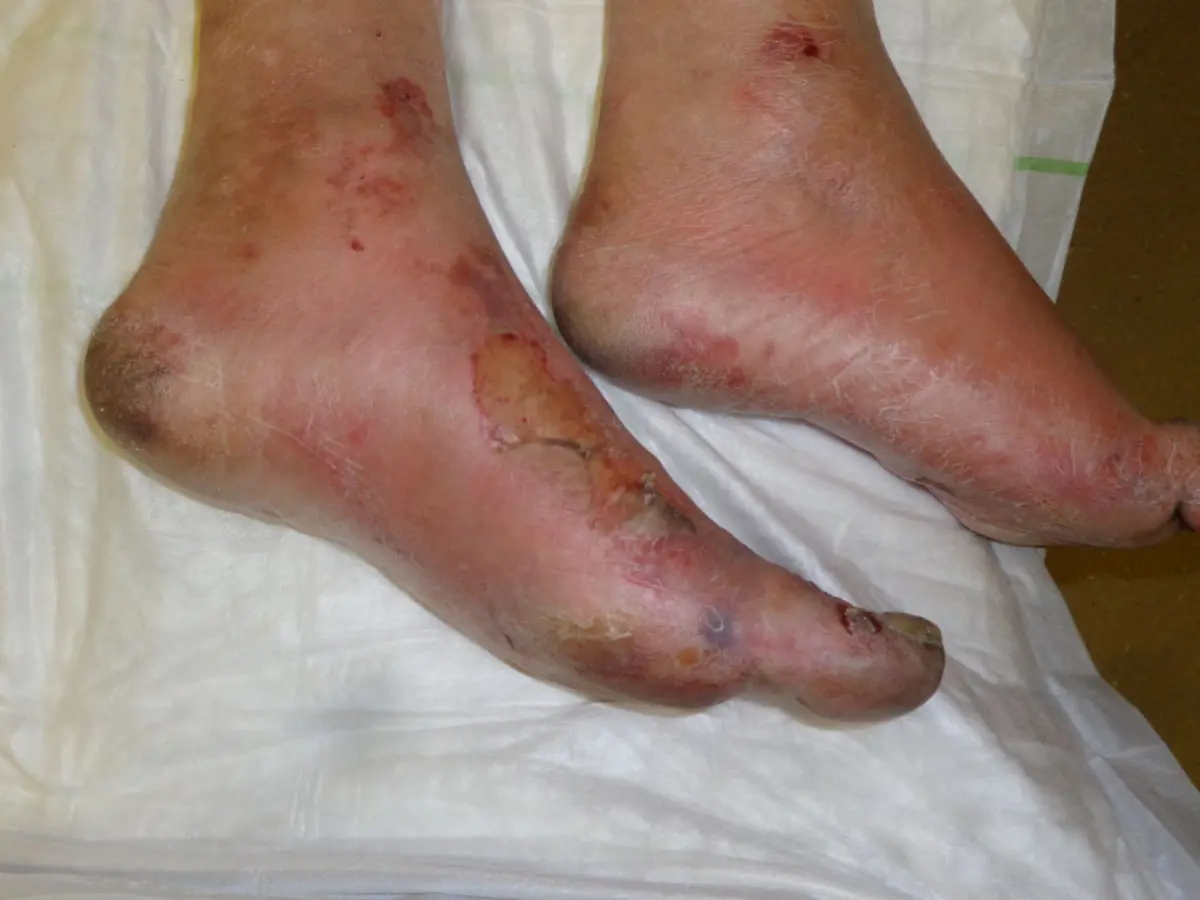 Erfrierung-AfroBrazilian-CC-BY-SA-3