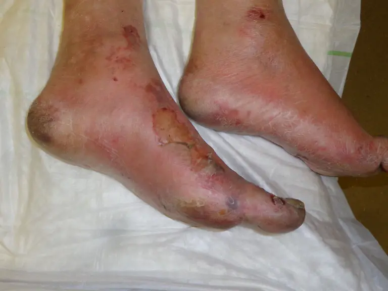 Erfrierung-AfroBrazilian-CC-BY-SA-3