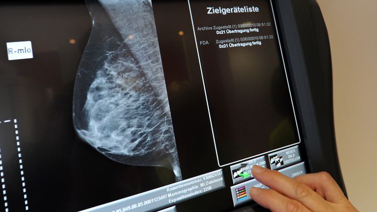 Mammografie ist eine Röntgenuntersuchung der Brust und gilt als gute Methode zur Früherkennung von Brustkrebs.