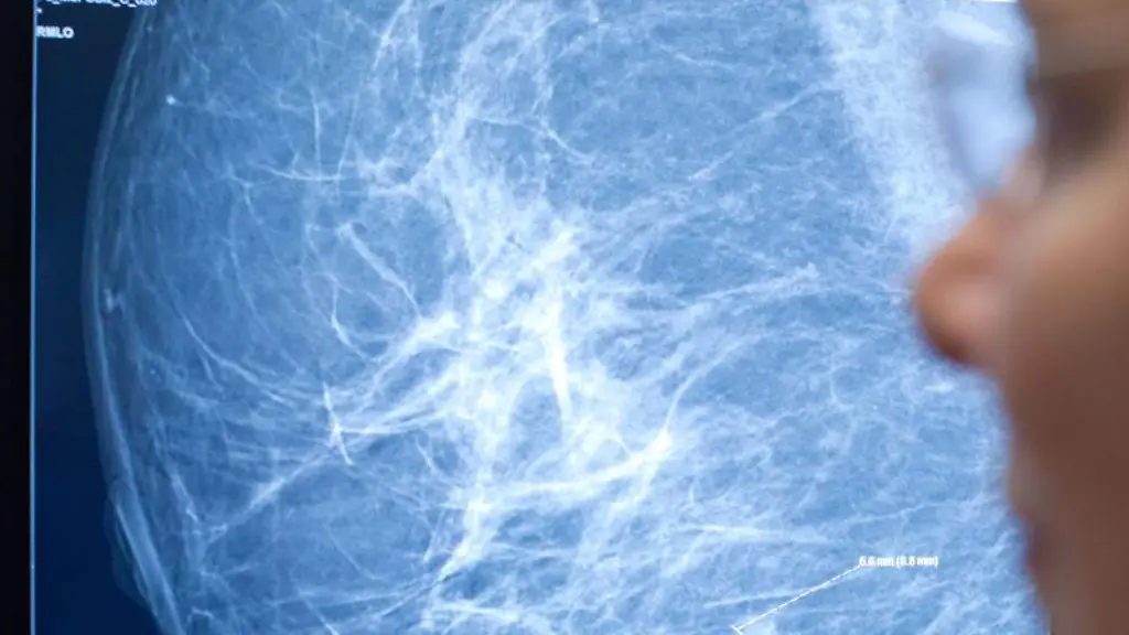 Mammographie-einer-weiblichen-Brust