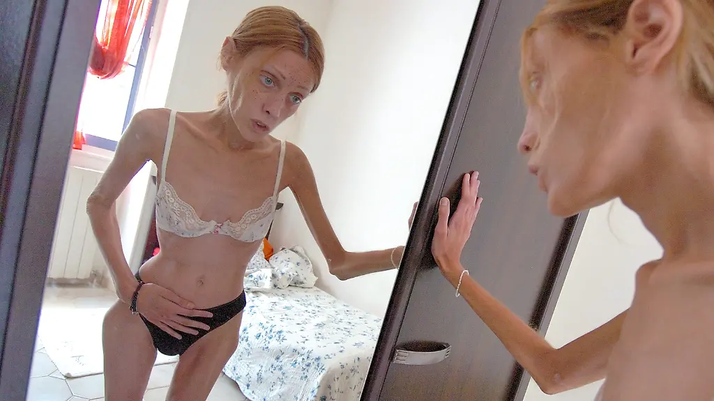 Das-verstorbene-franzoesische-Model-Isabelle-Caro-ist-wohl-die-bekannteste-Magersuechtige