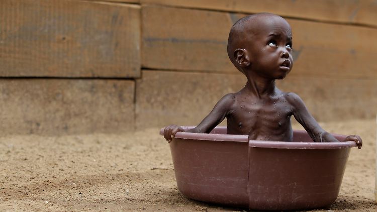 Dem zweijährigen Aden Saalad wird in Kenia von den "Ärzten ohne Grenzen" geholfen.