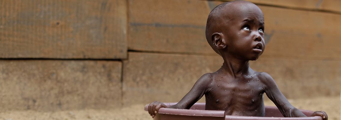 Dem zweijährigen Aden Saalad wird in Kenia von den "Ärzten ohne Grenzen" geholfen.