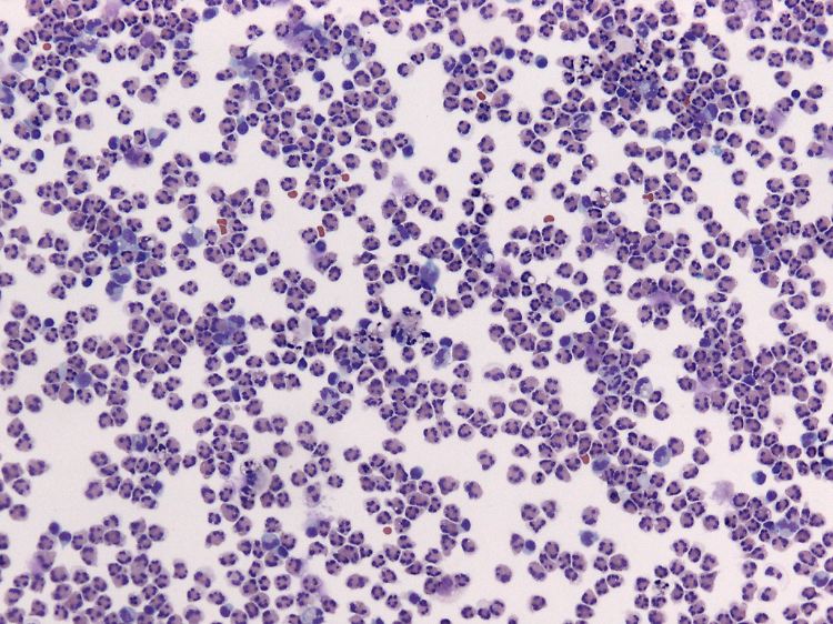 Die Vermehrung der Granulozyten (eine bestimmte Art weißer Blutkörperchen) in der Gehirn-Rückenmarksflüssigkeit eines Meningitis-Patienten.