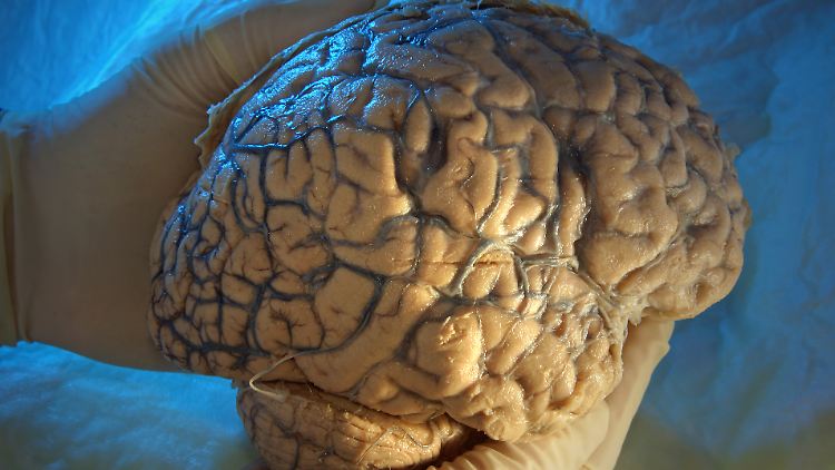 Alzheimer ist eine neurodegenerative Erkrankung des Gehirns.