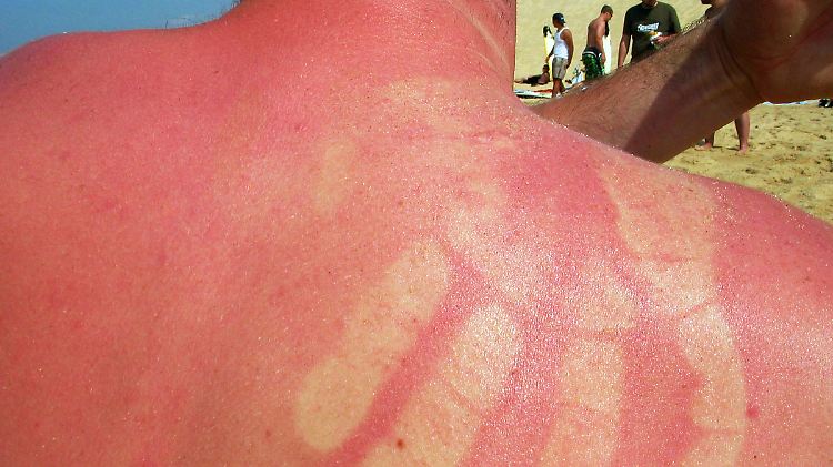 Autsch! Bei einem Sonnenbrand bleiben Abdrücke für ein paar Sekunden sichtbar.