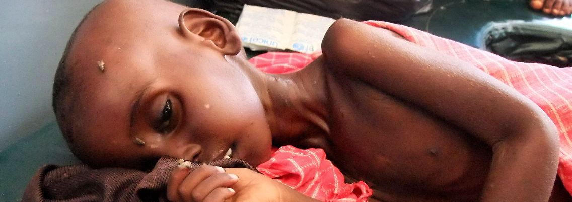 Farhiya Abdulkadir ist fünf Jahre alt. Der somalische Junge leidet an Unterernährung und wird in einem Hospital in Mogadischu behandelt.