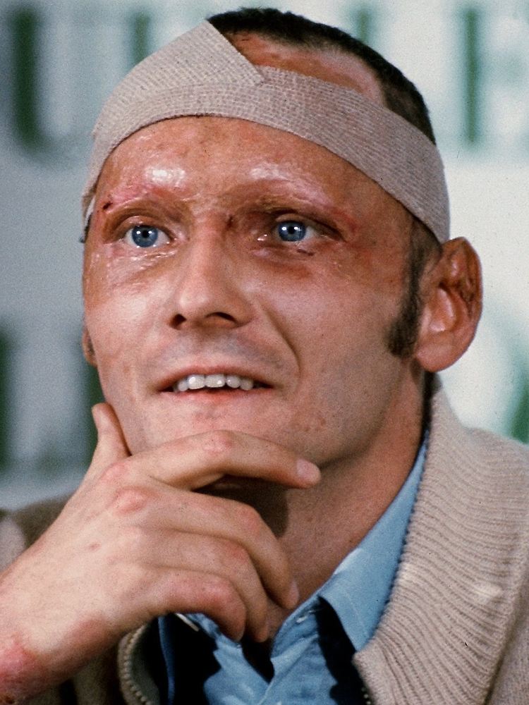 Das Gesicht verbrannt, ein Teil des rechten Ohres fehlt, zahlreiche Knochen gebrochen und die Lunge verätzt: Niki Lauda am 8. September 1976, fünf Wochen nach seinem Unfall.