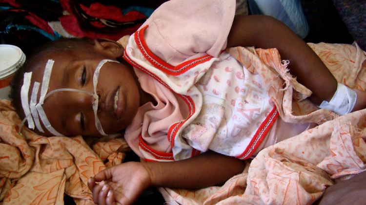 Ein unterernährtes Kind wird in einer Klinik in Mogadischu versorgt.