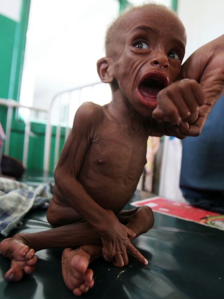 Ein unterernährtes Kind im Banadir-Krankenhaus in Magadischu. Etwa zwölf Millionen Menschen sind von der Dürre am Horn von Afrika betroffen.