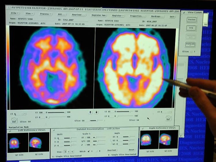 Die Gehirne eines gesunden Menschen (links) und eines Alzheimerpatienten unterscheiden sich deutlich.