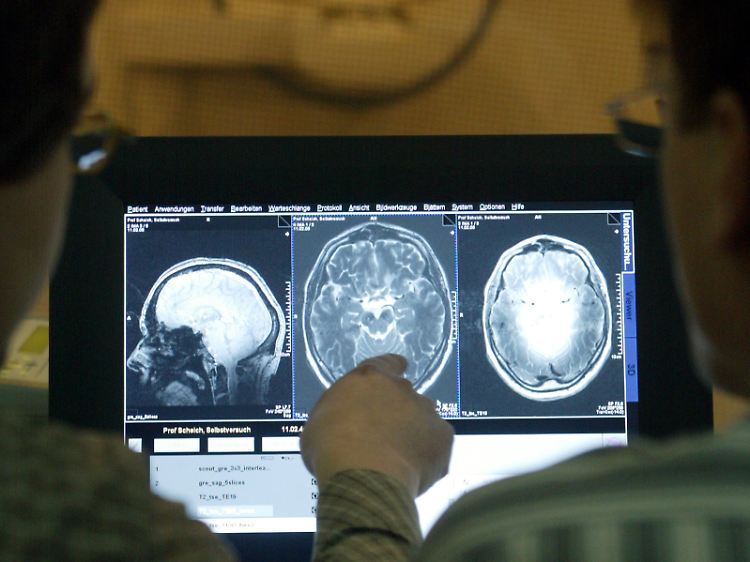 Multiple Sklerose kann mittels MRT anhand vernarbter Gewebebereiche diagnostiziert werden.