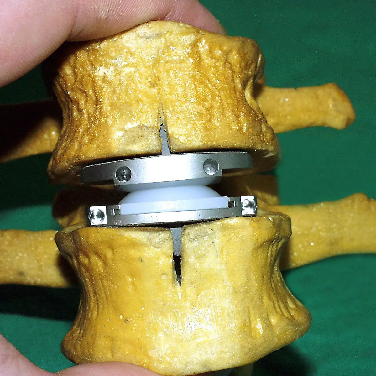 Pors und aus Titan: Neues Bandscheibenimplantat - ntv.de