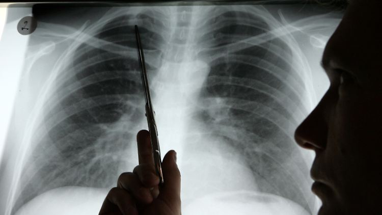 Diagnose Lungenkrebs: Nur wenige überleben die Krankheit.