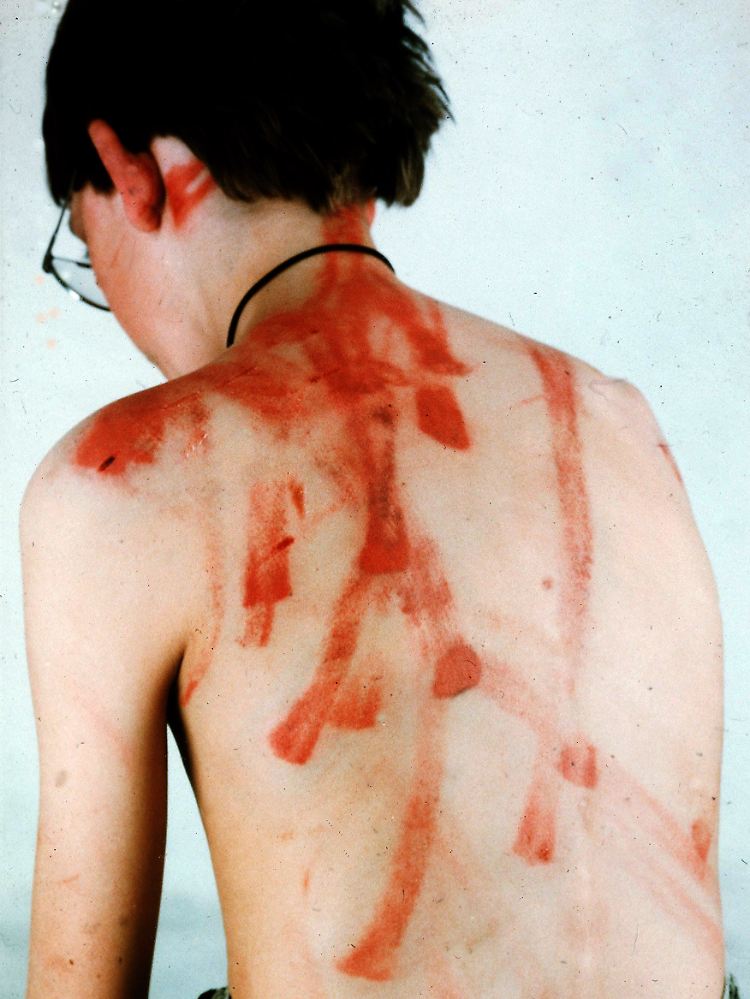 Das Foto des Instituts für Rechtsmedizin in Eppendorft/Hamburg zeigt Spuren einer Kindesmisshandlung.