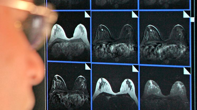 Bildschirmdarstellung einer Magnetresonanz-Mammographie. Eine von zehn Frauen bis 75 Jahren erkrankt in Deutschland an Brustkrebs.