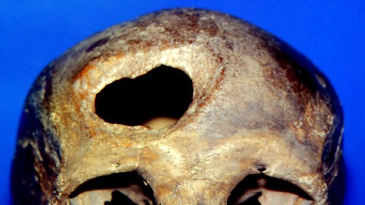 Auch dieser Schädel aus der frühen Bronzezeit, etwa 1700 v. Chr., der in Pätschow bei Anklam gefunden wurde, zeigt eine Trepanation.