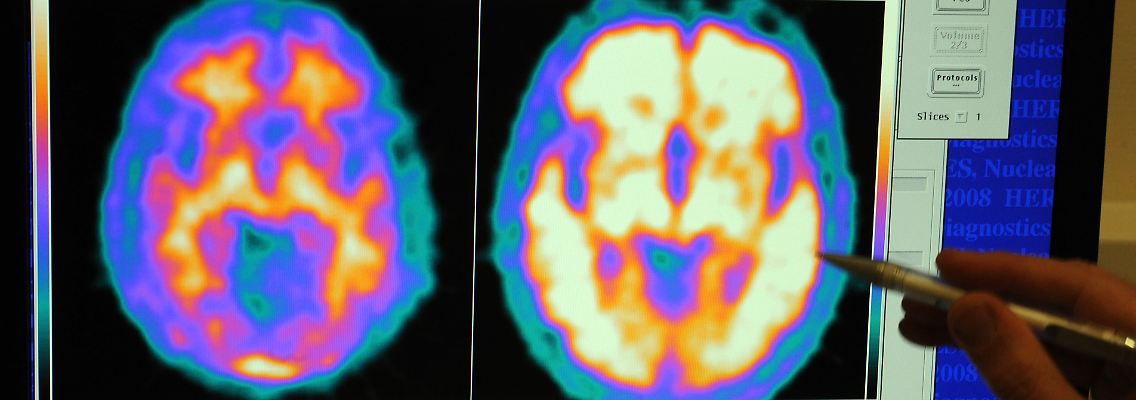 Die Alzheimerforschung blickt mit moderner Technik direkt ins menschliche Gehirn.
