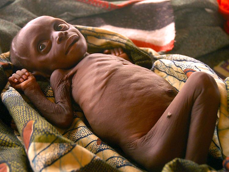 Mehr als drei Millionen Kinder sterben jährlich an Unterernährung.