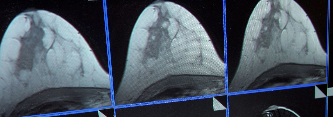 Die Bildschirmdarstellung einer Magnetresonanz-(MR)-Mammographie.