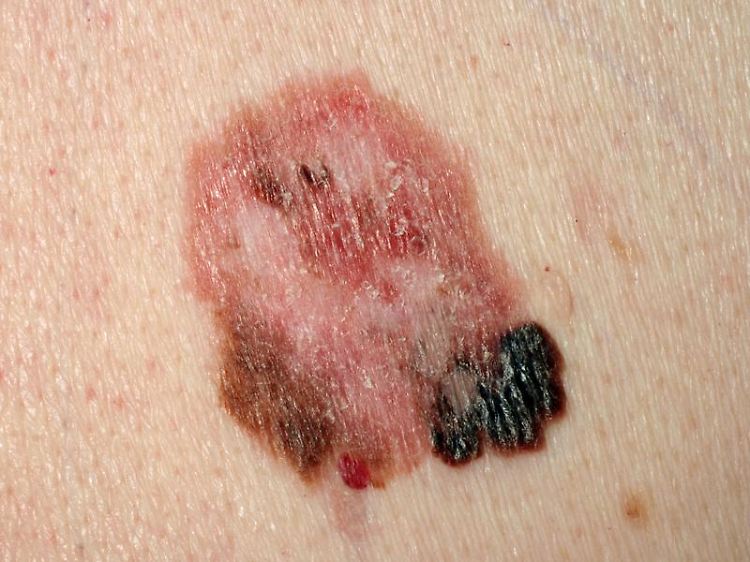 Zu viel Sonne und häufige Nutzung von Solarien begünstigen das Entstehen von schwarzem Hautkrebs.