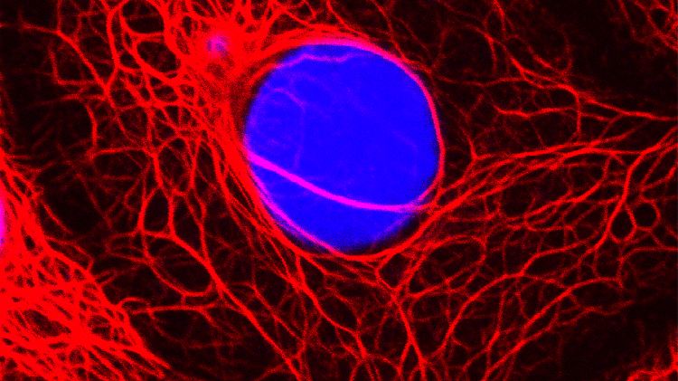 Das Medikament Aromsin soll Brustkrebs (im Bild: eine Brustkrebszelle) vorbeugen.