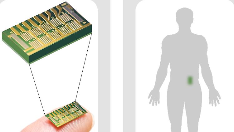 Darstellung eines Microchips, wie er jetzt bei Osteoporose-Patientinnen getestet wurde. 