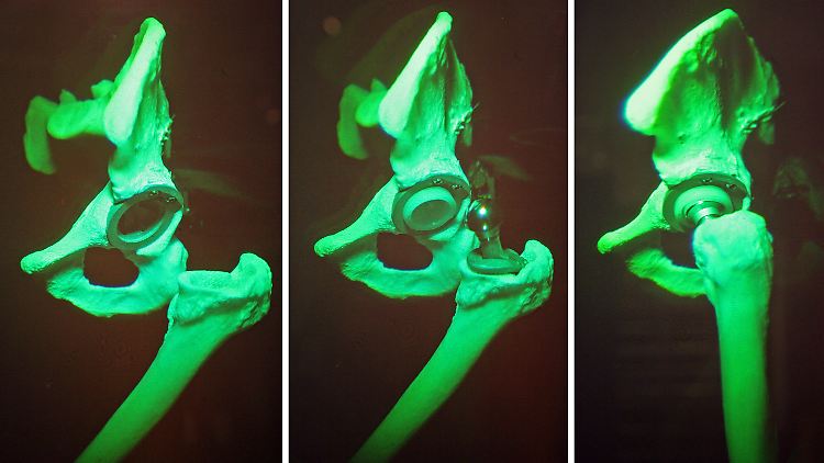 Hüftgelenk mit Gelenkprothese: Wie gefährlich sind Metall-auf-Metall-Implantate?