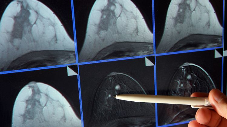 Hier deutlich erkennbar: ein kleiner Tumor, der sich in der Brust gebildet hat. In den USA bleibt der Brustkrebs bei 10 bis 20 Prozent der erkrankten Frauen mit der Mammographie unentdeckt.