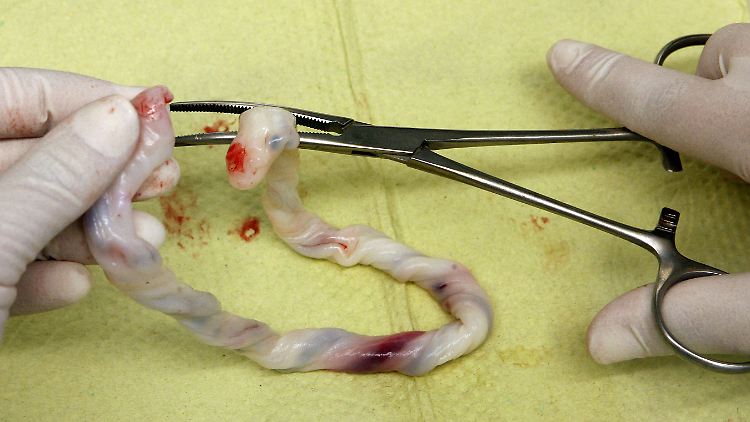 Stammzellen werden zum Beispiel aus Nabelschnurblut gewonnen.