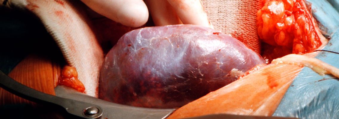 Während einer lebensrettenden Nierentransplantation.