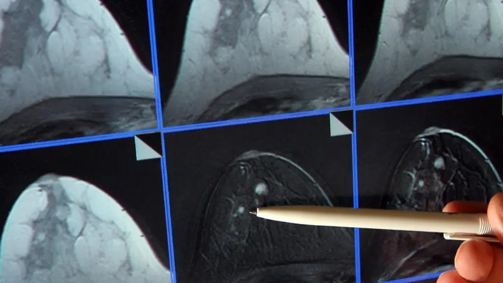 Durch-die-Mammographie-werden-selbst-winzige-Tumore-sichtbar-Jetzt-haben-Forscher-einen-neuen-Ansatz-zur-Vermeidung-von-Brustkrebs-gefunden