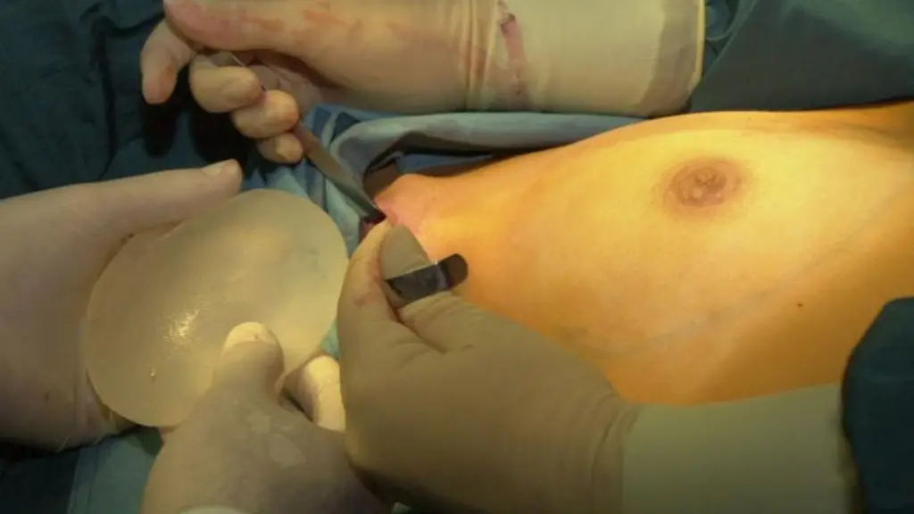 Schoenheitsoperationen-an-der-Brust-haben-ihren-Preis-Angebote-unter-5000-Euro-sind-haeufig-unserioes