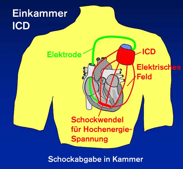 ICD-1-Schockwellen-Copyright-Biotronik