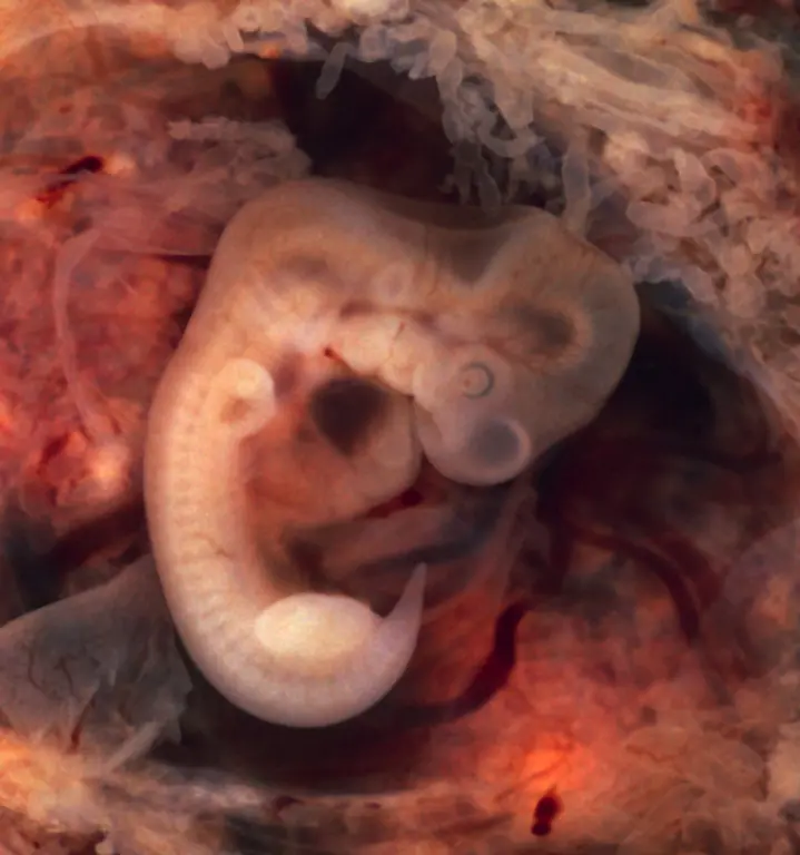 Tubal-Pregnancy-with-embryo