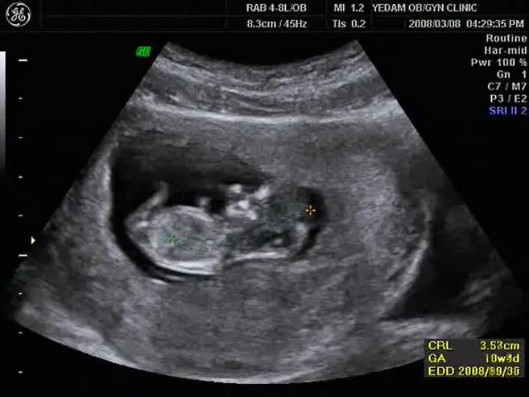 mid-RyuJin-in-the-womb-heart-beating-ogg