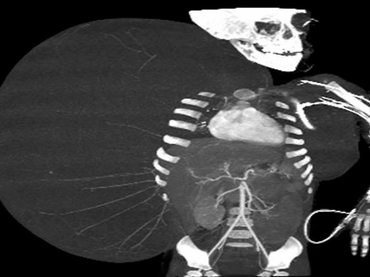 Die Ausmaße des Tumors auf einem Röntgenbild.