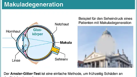 Neues Verfahren bei altersabhngiger Makuladegeneration - Netzhautimplantat  kann bei fast Blinden das Sehvermgen verbessern - ntv.de