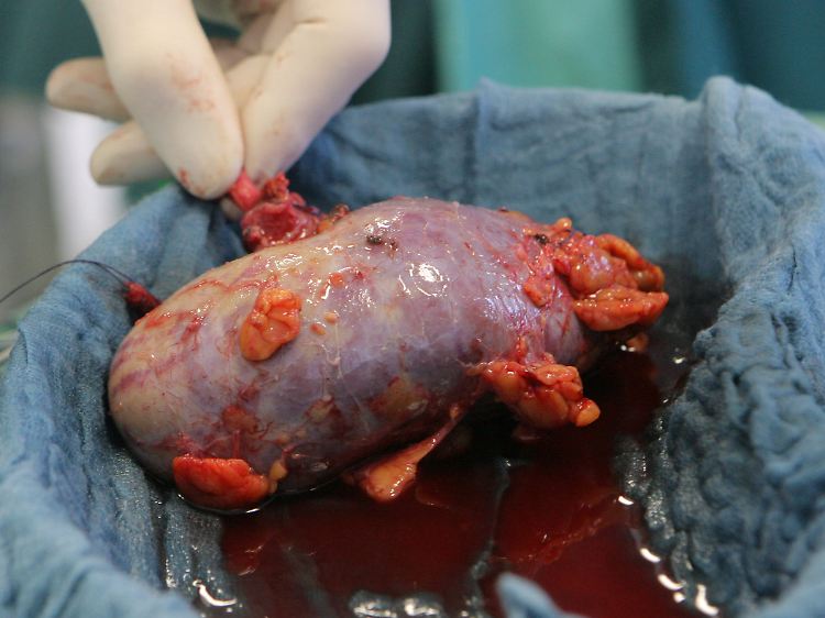 Organspenden sind eine blutige Angelegenheit. Durch den Göttinger Skandal gleich im doppelten Sinne.