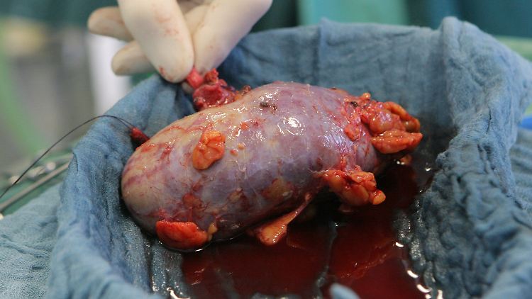 Eine Spenderniere vor der Transplantation.