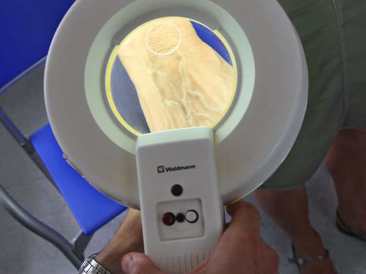 Ein Hautarzt untersucht mit einem Vergrößerungsglas die Haut einer Patientin bei einer Hautkrebs-Früherkennung. Immer mehr Menschen erkranken jedes Jahr neu an Krebs.