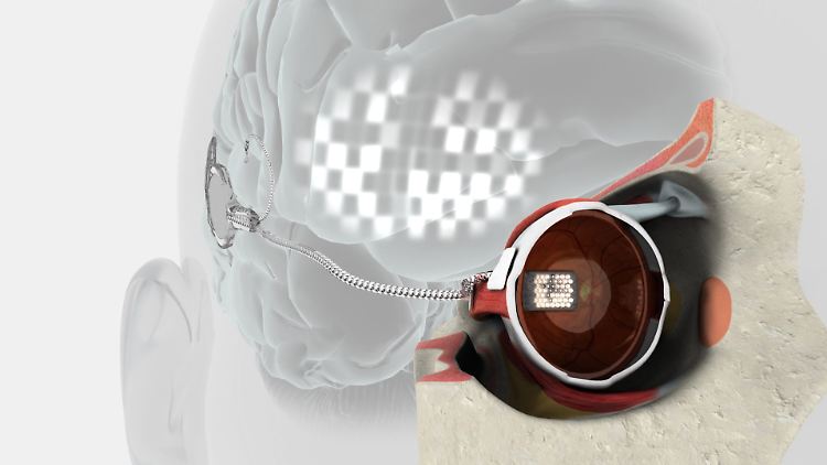 Computergrafik des "frühen Prototyps eines bionischen Auges" von Bionic Vision Australia.