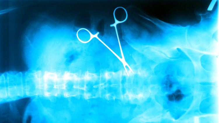 In besonders schweren Fällen von Ärztepfusch werden auch schonmal OP-Klemmen im Körper eines Patienten gefunden.