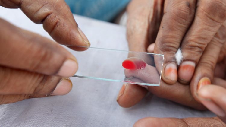 In Kolkata (Indien) wird ein Patient auf Malaria getestet.