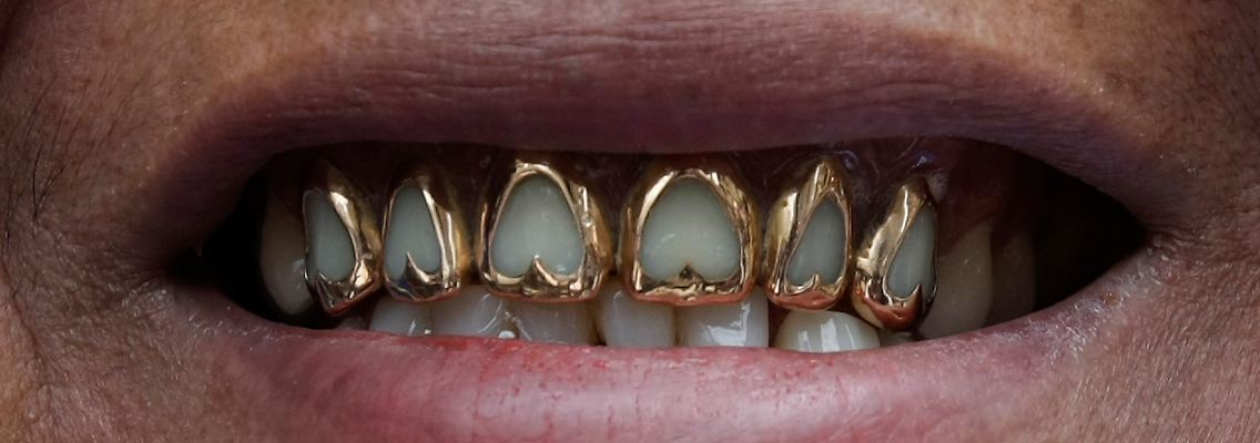 Auch Zahngold befand sich unter der Beute, die noch nicht wieder aufgetaucht ist.
