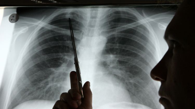 Dieses Röntgenbild weist auf ein Lungenkarzinom hin. Nach einer Schätzung des Robert-Koch-Instituts wird 2010 fast jede Minute eine neue Krebsdiagnose gestellt.