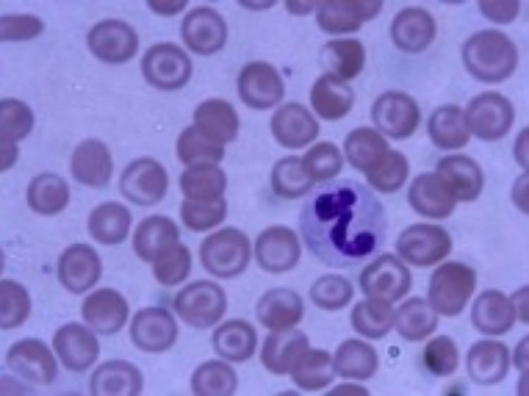 Rote Blutkörperchen, sichelförmig deformiert.